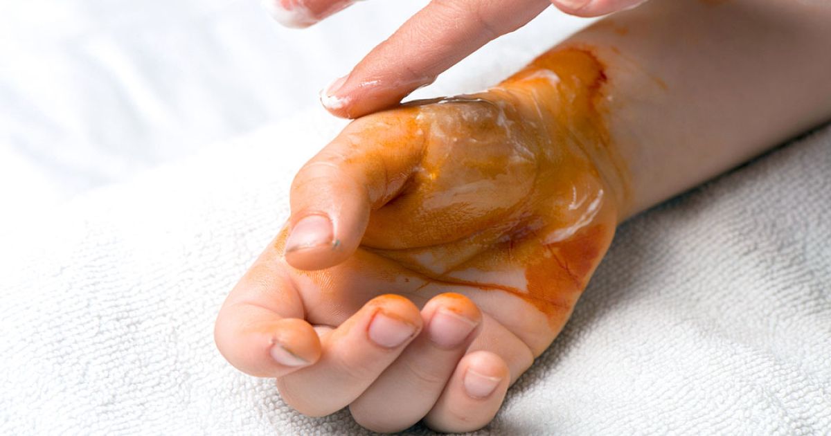 আগুনে পুড়ে গেলে যা করবেন